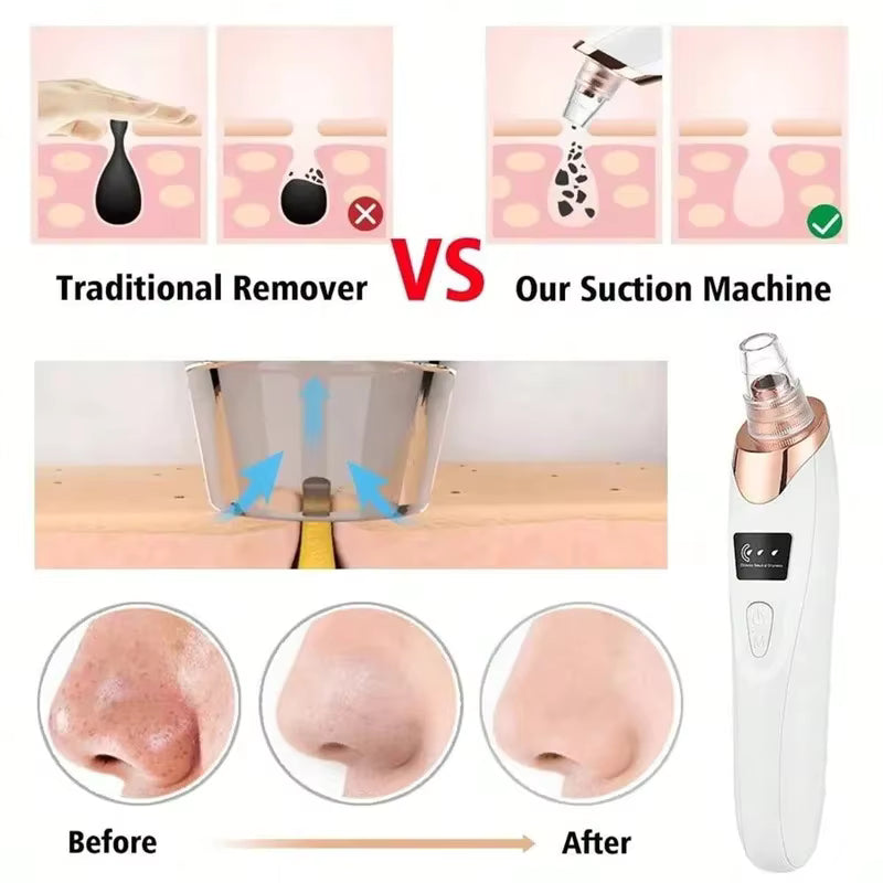 Blackhead Remover Vacuum Pore Cleaner